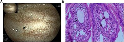 Case report: Noonan syndrome with protein-losing enteropathy